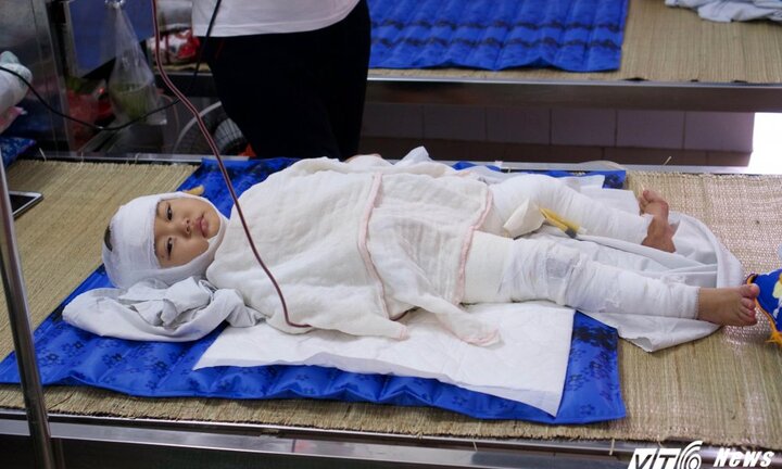 Thương tâm cháu bé bị bỏng nặng do ngã vào nước tẩy nhà vệ sinh