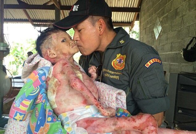 Cô bé mắc căn bệnh ‘da bướm’ hiếm gặp, 50.000 người mới có một người mắc