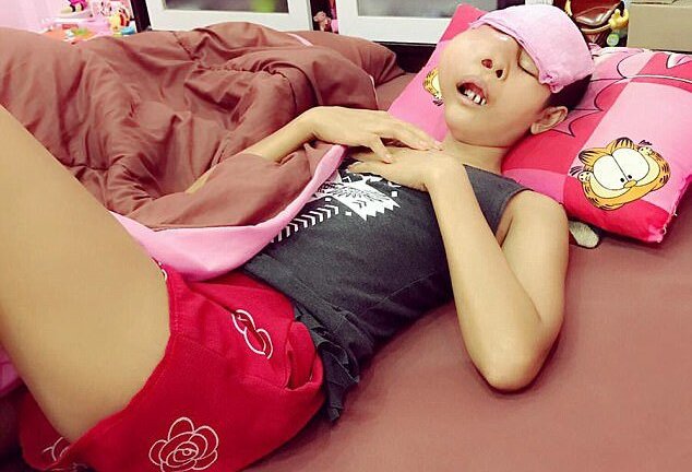 Khám đau răng, cô gái phát hiện bị ung thư hàm giai đoạn cuối