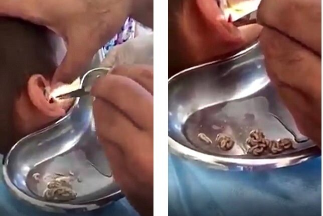 Kinh hoàng cảnh bác sĩ gắp hàng chục con giòi ra khỏi tai cậu bé
