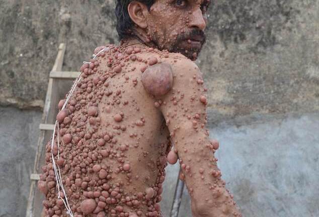 Người đàn ông mọc hàng ngàn khối u trên cơ thể như 'quái vật'