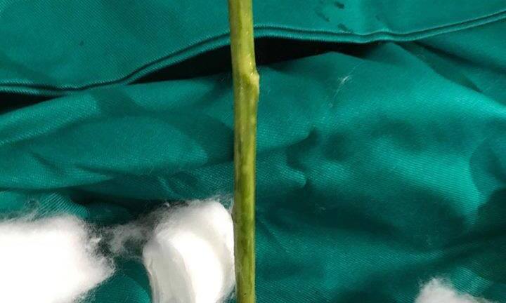 Hy hữu: Một người phụ nữ tự phá thai, để quên cái que trong cơ thể