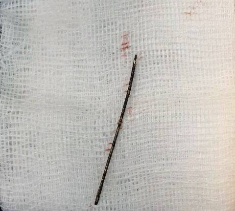 Hy hữu: Phát hiện cây kim 4 cm trong lồng ngực bé gái 3 tuổi, do bị ngã từ 2 năm trước