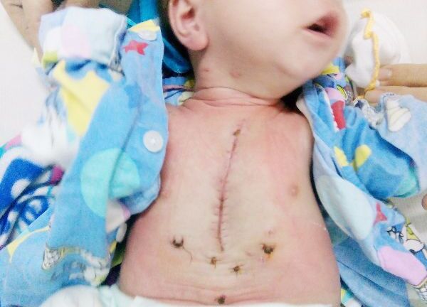 Bác sỹ căng mình 5 tiếng cứu bé sơ sinh bị tim bẩm sinh dạng nặng nhất