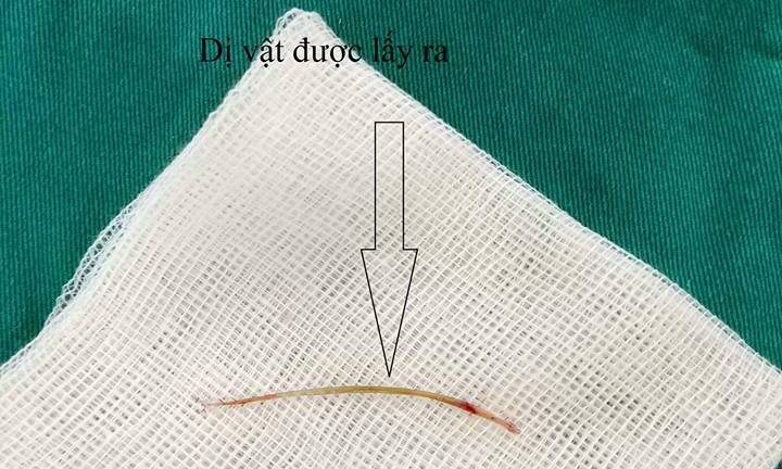 Ăn cá hóc xương, cụ già 72 tuổi bị thủng ruột