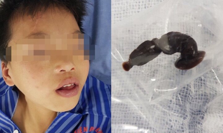 Bác sĩ gắp con đỉa dài 6cm trong cổ họng bệnh nhi 13 tuổi