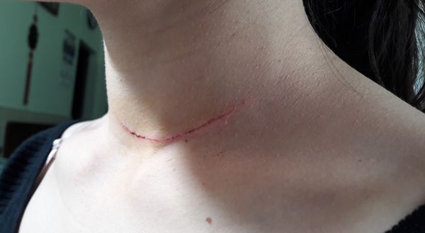 Mời khách vào quán ăn, thiếu nữ ở Hà Nội bị chém vào cổ