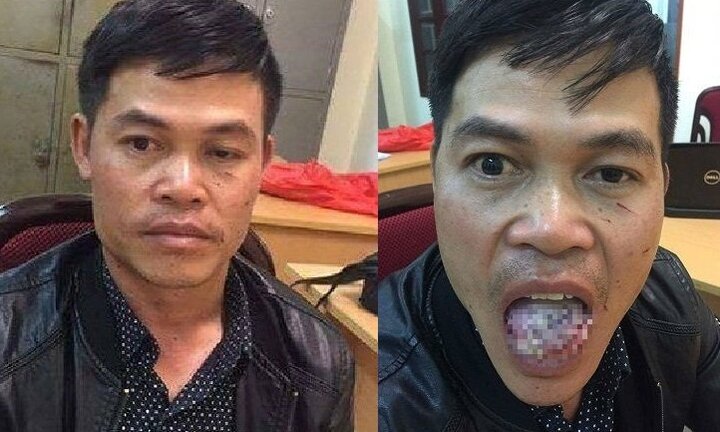 Khởi tố kẻ hiếp dâm bị cô gái cắn gần đứt lưỡi