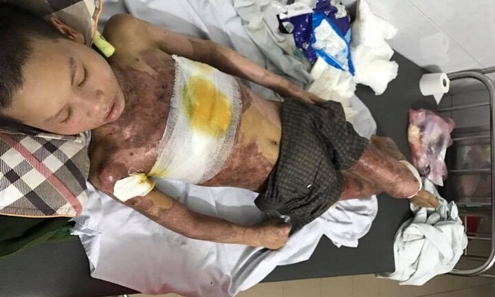 Xót xa bé trai người Dao đỏ học giỏi bị bỏng toàn thân khi đi chăn trâu