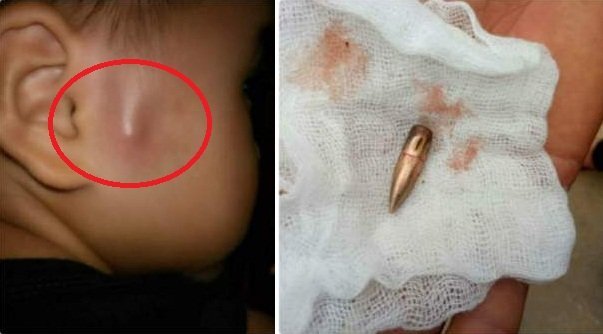 Đang ngồi trong lớp, bé trai bị đạn lạc rơi trúng đầu ở Vĩnh Phúc