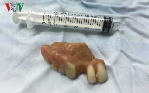 Ăn bún vô tình nuốt luôn răng giả