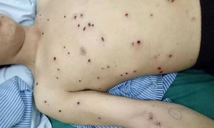 Đi lấy gỗ làm nhà, bị bắn 53 viên đạn hoa cải vào người