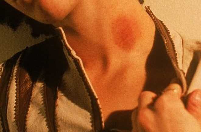 Bị bạn gái cắn yêu, chàng trai mất mạng