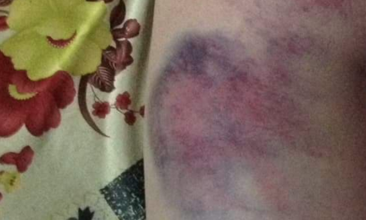 Đắk Lắk: Nghi vấn giáo viên đánh bầm tím mông học sinh lớp 4