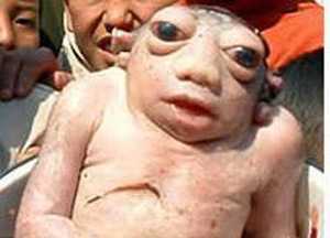 Những em bé dị dạng khủng khiếp