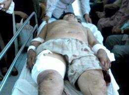 Tự ý rút mảnh kính cắm ở đùi: Mất máu, suýt chết