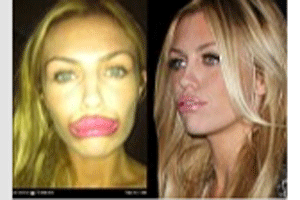 Abbey Crouch khoe môi sưng mọng vì 'dao kéo'