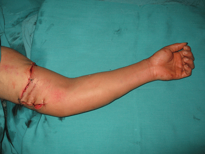 Châm lửa đốt mìn, nam thanh niên đứt lìa cánh tay