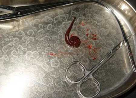 Gắp con đỉa gớm ghiếc trong khí quản bé gái 5 tuổi