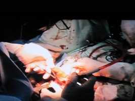 Ca mổ cho cô gái mắc “bệnh quỷ” bước đầu thành công