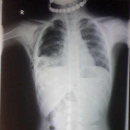 Bị trâu húc, cháu gái 7 tuổi nguy kịch