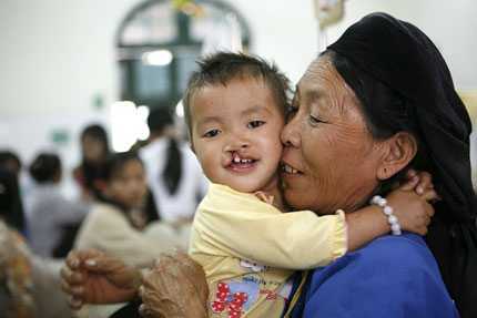 BS Đức phẫu thuật miễn phí dị tật vùng mặt