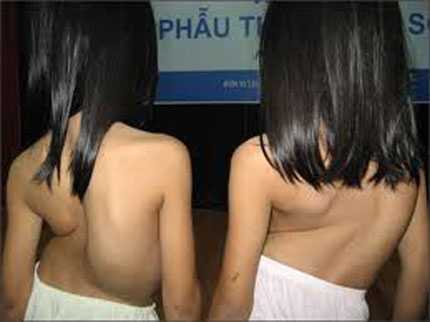 Giáo sư Mỹ khám miễn phí vẹo cột sống cho trẻ em