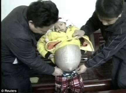 Bé 12 tuổi bụng sưng như mang bầu