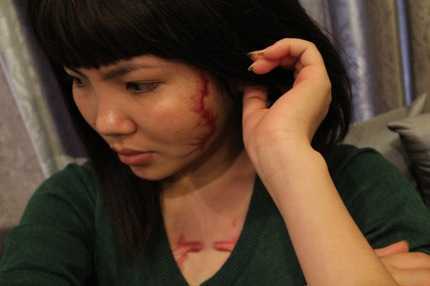 'Cô gái mặt rết' tiếp tục ra Hà Nội điều trị