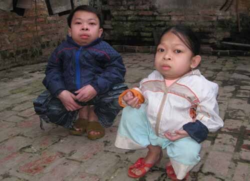 Thương tâm hai anh em mắc bệnh 'người ếch'