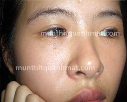 Mụn thịt nổi như da cóc: Xinh như mộng cũng thành xấu