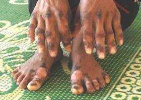 Bộ Y tế quyết tìm nguyên nhân 'bệnh lạ' ở Quảng Ngãi