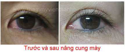 Tận mắt xem bác sĩ nâng cao cung mày