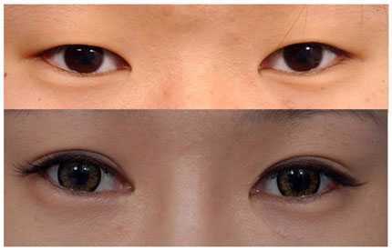 Mắt một mí: Bạn nên bấm mí hay cắt mí?