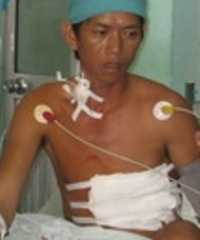 Ngư dân bị cá cờ 50kg đâm thủng tim