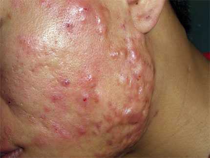 Mặt đầy mụn bọc: Nam thanh niên ngại yêu