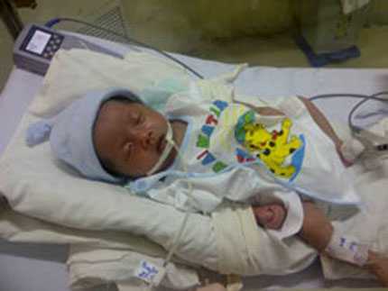 Dùng keo sinh học bít rò mạch máu não trẻ sơ sinh