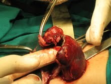 Cắt thận gây nhiễm trùng bằng dao cắt đốt siêu âm