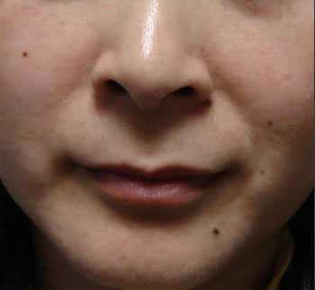 Hốt hoảng đi tẩy nốt ruồi 'tuyệt tự đường con cái'