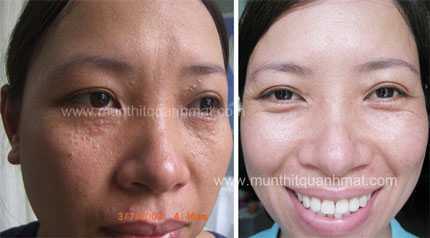 Lưu ý khi chữa mụn thịt, tránh biến chứng thành sẹo