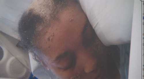 Thiếu nữ bị bệnh lạ: Mọc móng tay trên đầu