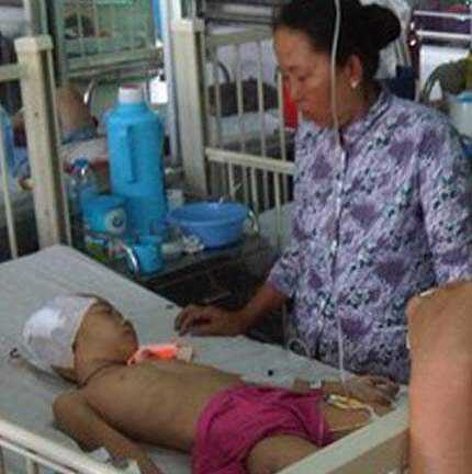 Ngã ở trường, bé gái 6 tuổi nứt sọ