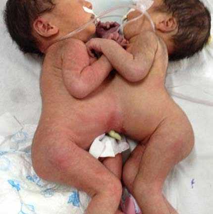 TP.HCM: Hai bé gái song sinh dính liền bụng ngực