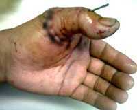 Gần đứt rời ngón tay do chặt cây