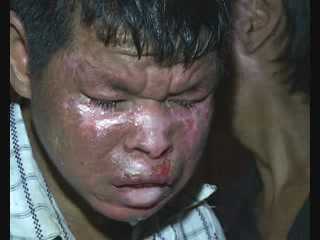 Video: Gặp lại những người bệnh khủng khiếp ở Hoà Bình