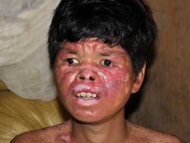 Những người bệnh khủng khiếp ở Hoà Bình, giờ ra sao?