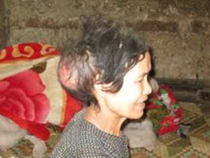 Cám cảnh người đàn bà 'hai đầu' giữa thung lũng