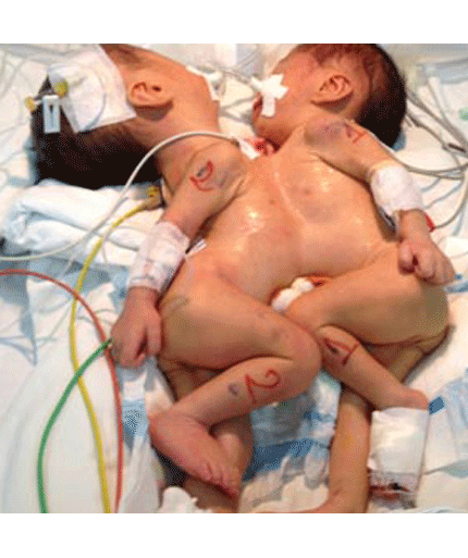 TP.HCM:Thêm một cặp song sinh dính liền cực kì phức tạp