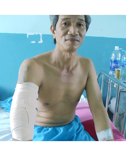 Bóc tách thành công khối u 2kg ở cánh tay