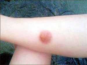 Bỏng pô xe máy, ăn gì nhanh lành sẹo?